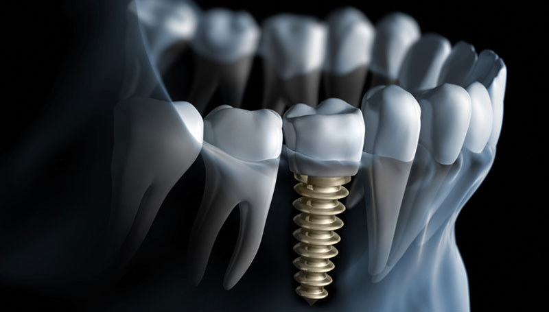 Common Myths About Dental Implants Debunked