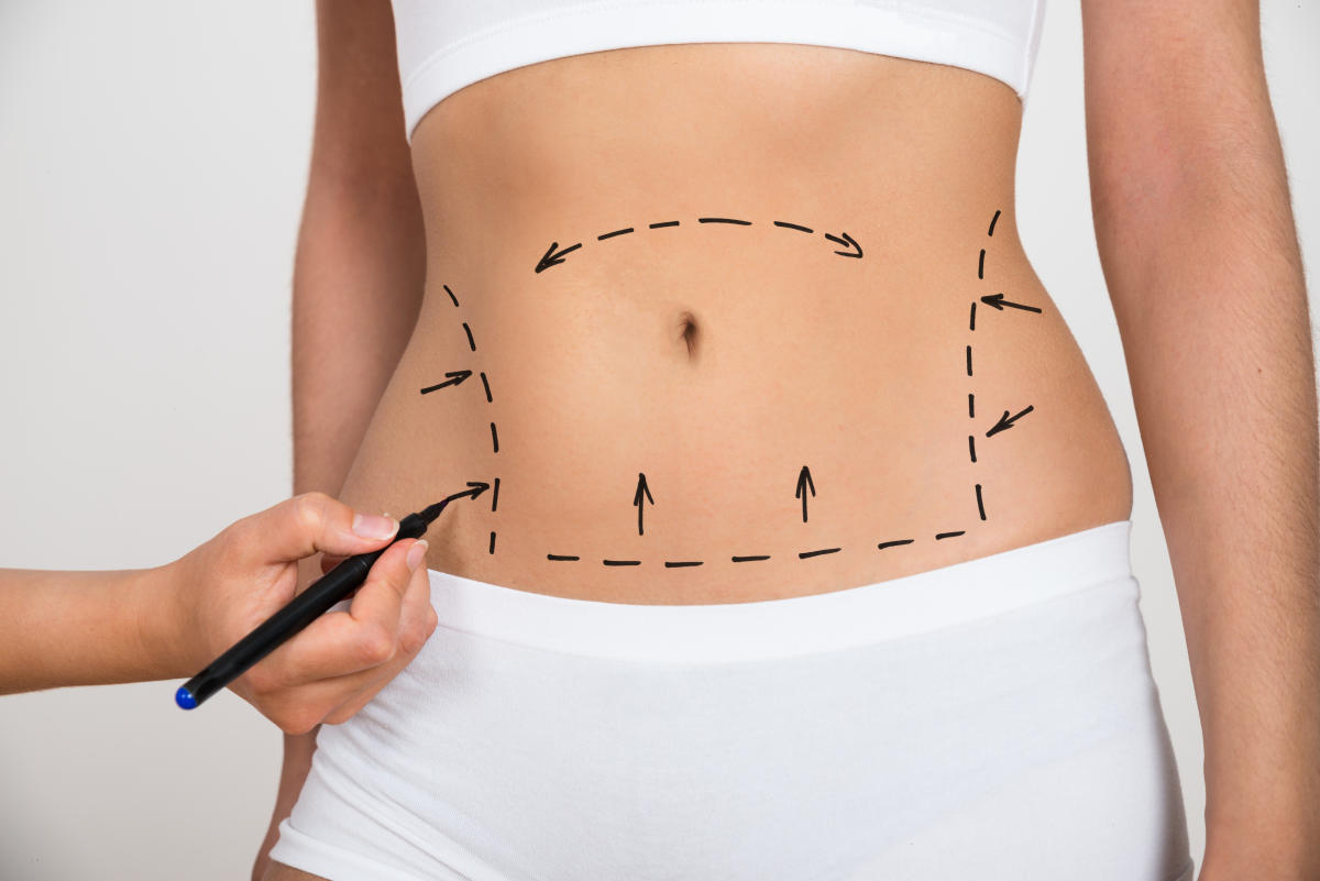Liposuction: The Key to a Contoured Body