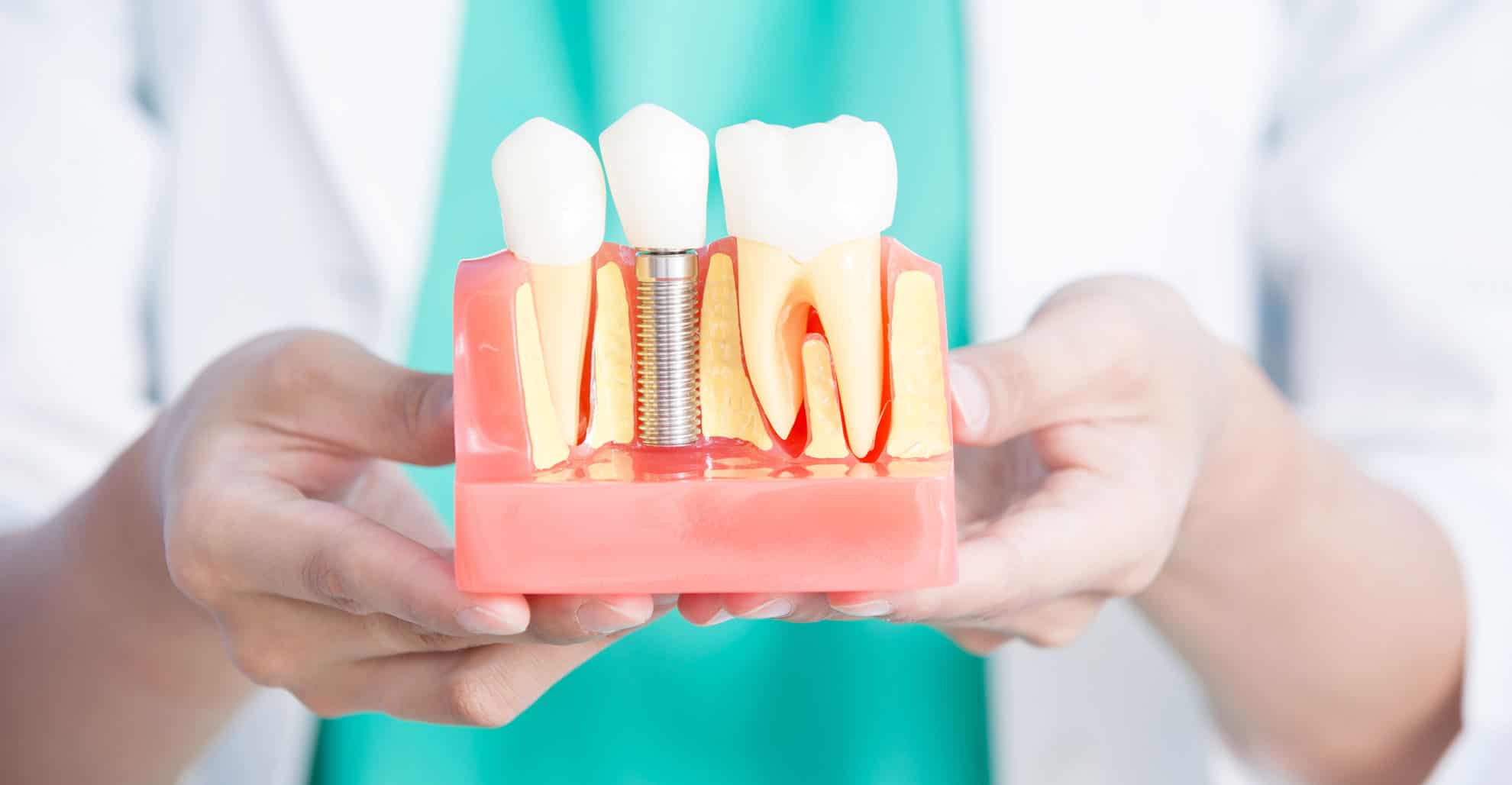 How Dental Implants Can Improve Speech and Confidence