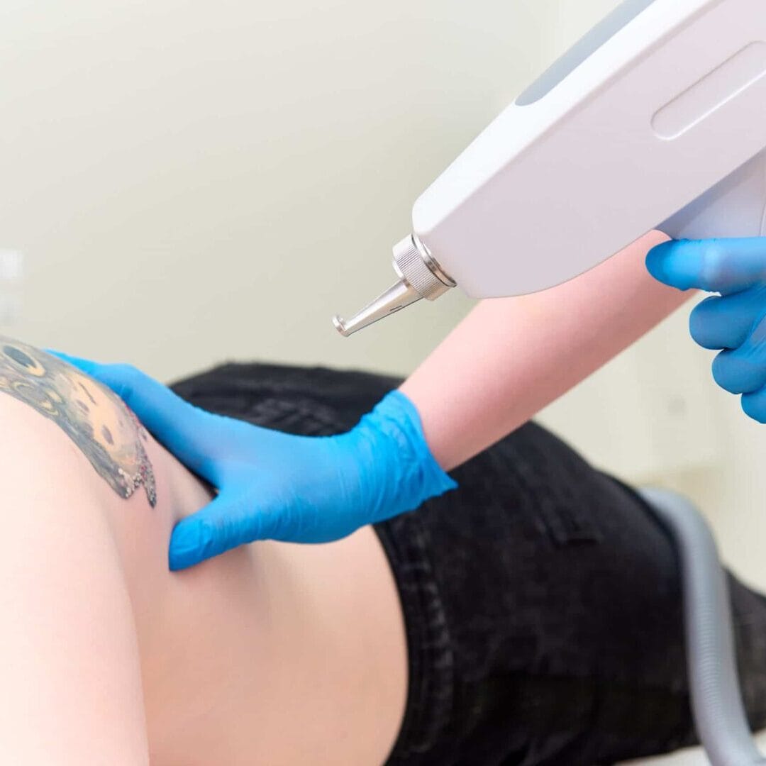 Clear Your Skin with Cutting-Edge Picosure Tattoo Removal Today