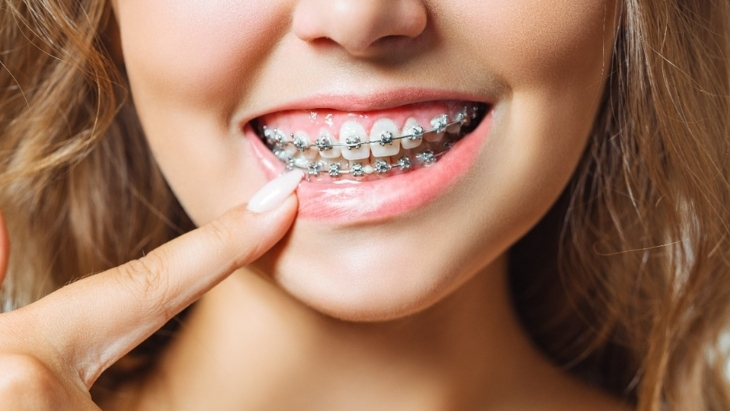 Are Braces Safe for Active Kids Who Play Sports?