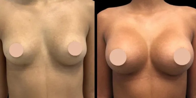 Breast Augmentation and Body Contouring: The Best Doctors in Dubai Share Their Expertise