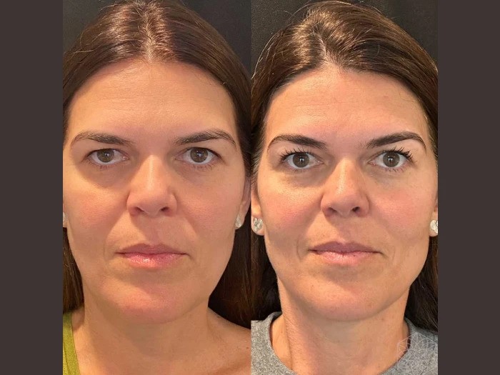 Thread Lift for Under-Eye Bags: How the Best Aesthetic Clinic in Dubai Can Help