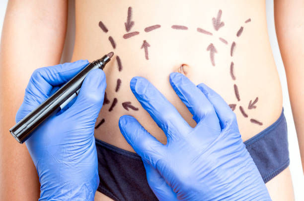 Discover the Best Tummy Tuck Procedures in Riyadh