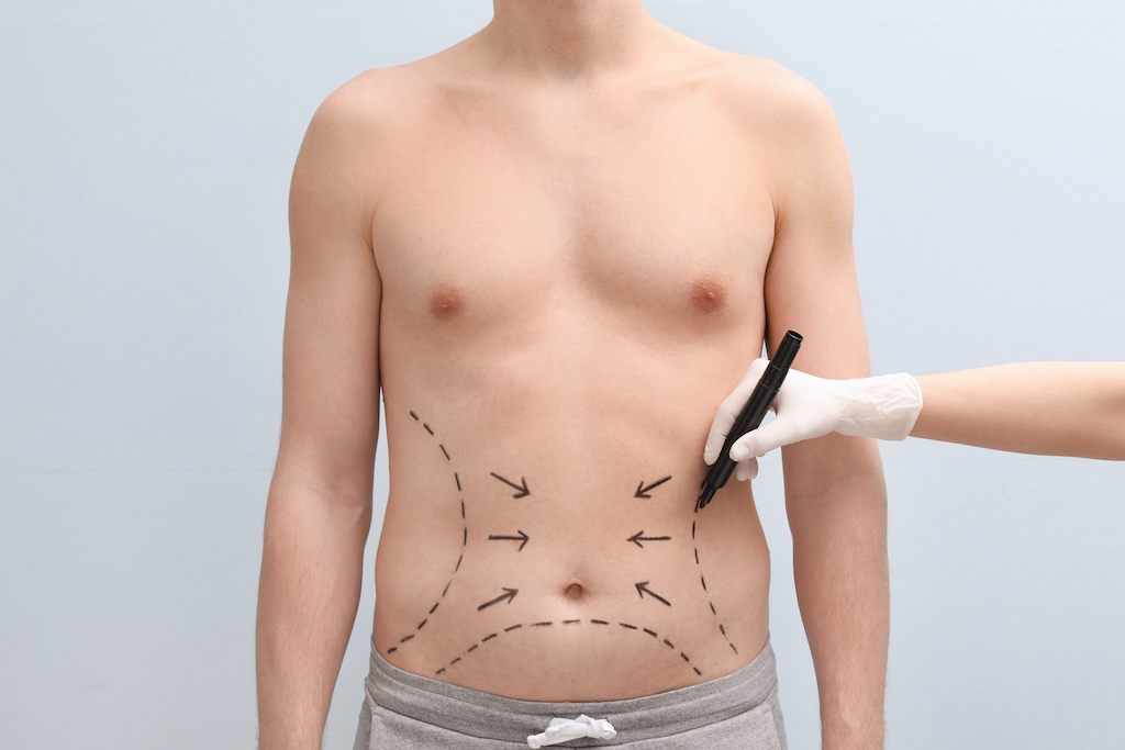 Liposuction for Men: Sculpted Chest & Abs