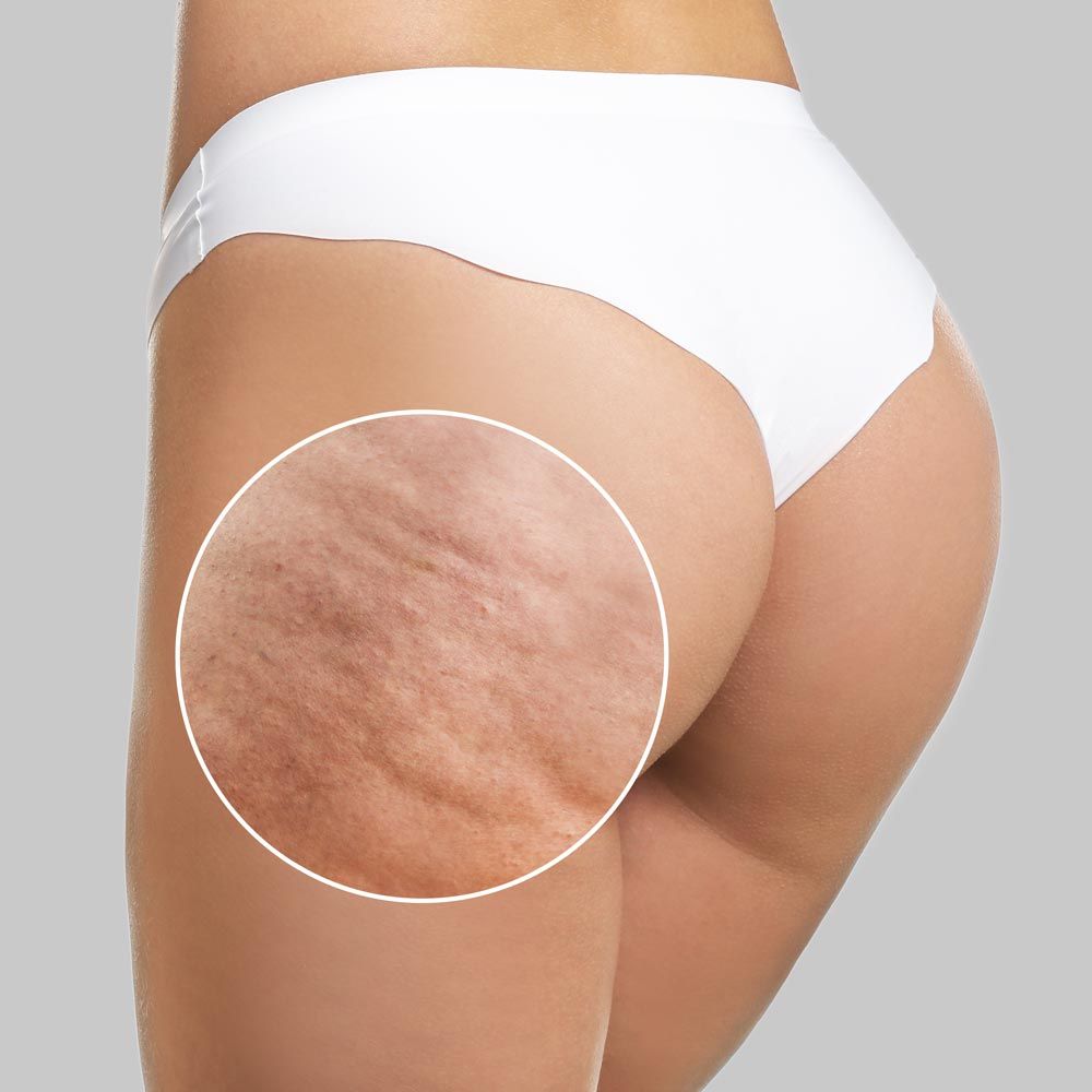 Is cellulite treatment expensive?