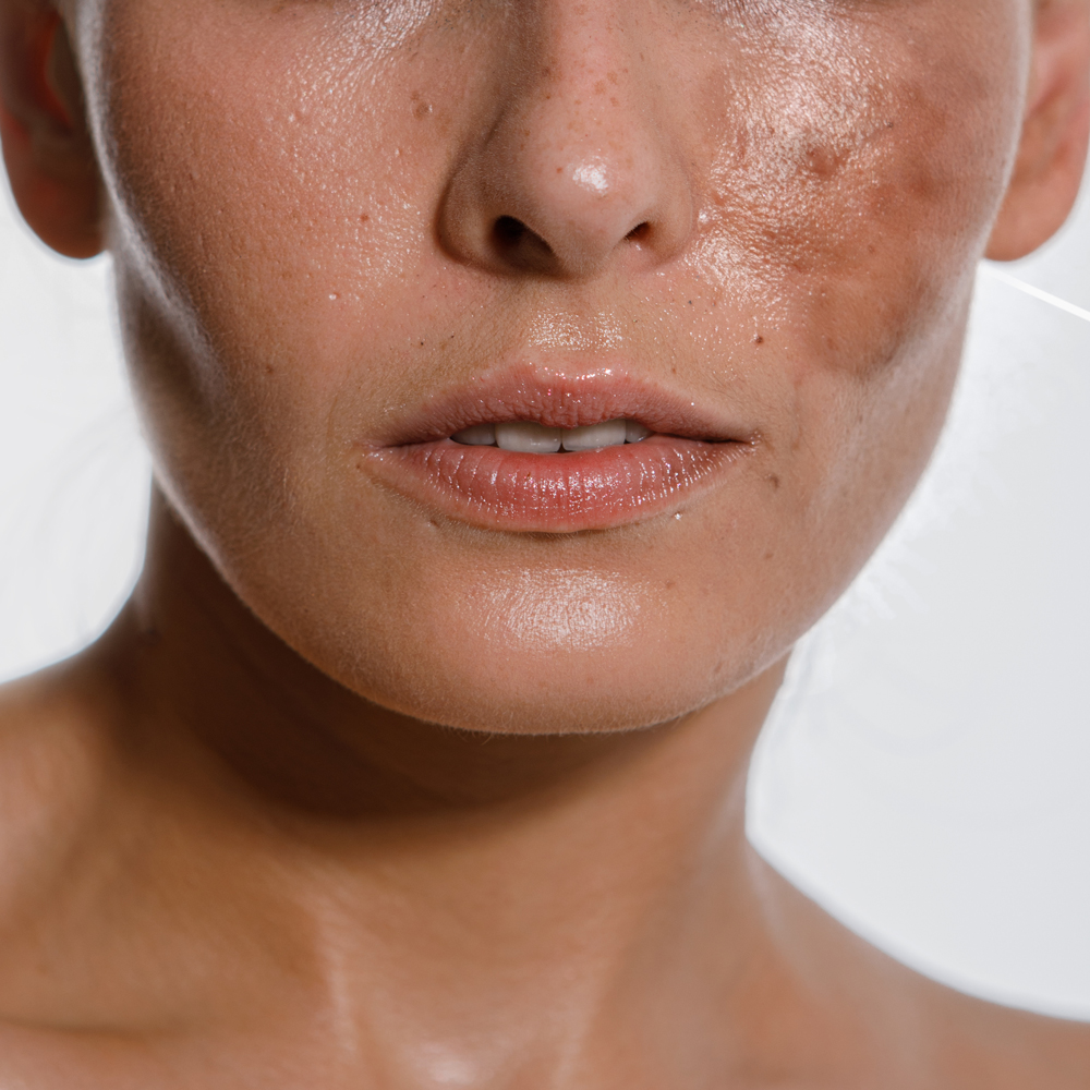 What fades hyperpigmentation the fastest?