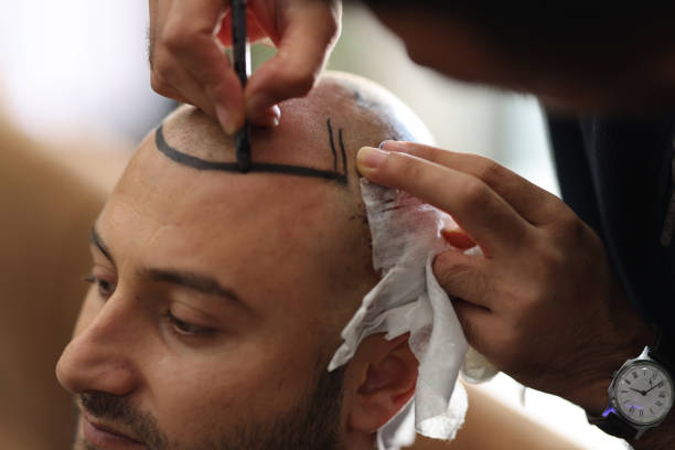 Dubai Hair Transplant: Scar Care Tips