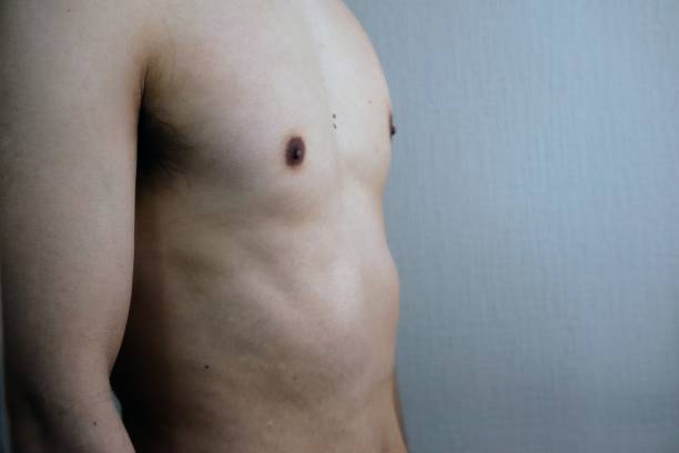 What to Expect from Gynecomastia Surgery in Riyadh