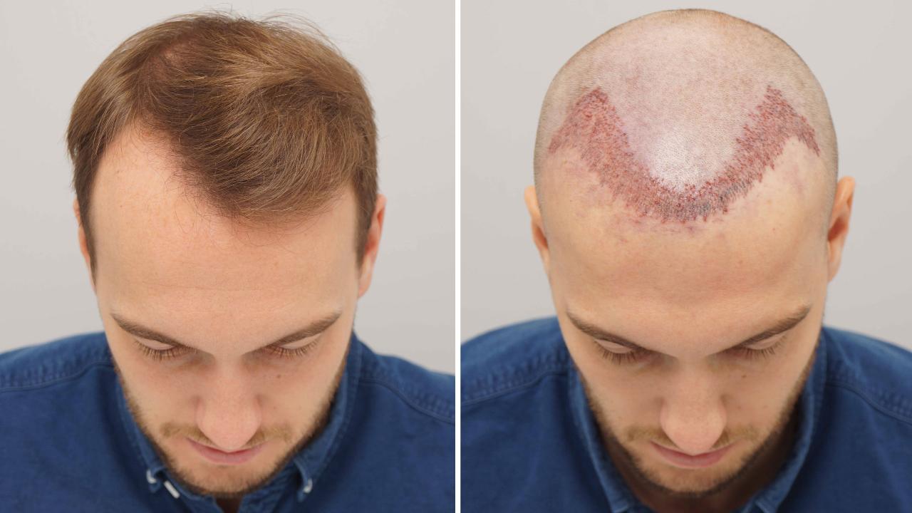 Hair Transplant in Dubai: Everything You Need to Know Before Going Under the Needle