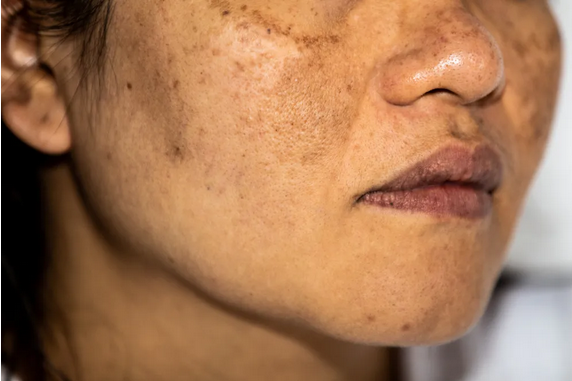 Customized Treatment Plans at Cheshire Pigmentation Clinics