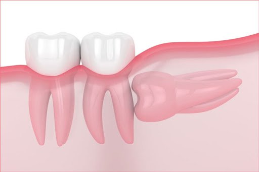 Giá nhổ răng khôn bảo hiểm y tế: Hiểu đúng để điều trị hiệu quả và tiết kiệm