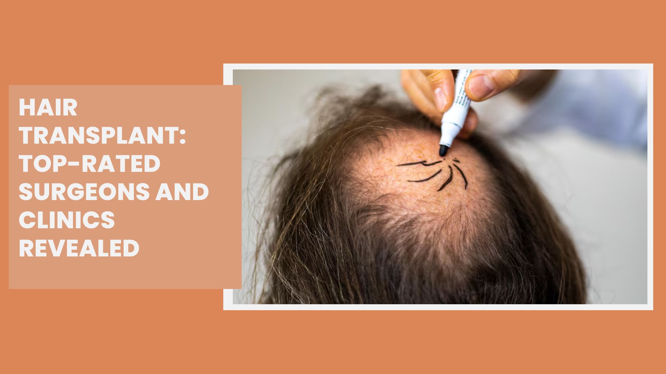 Hair Transplant: Top-Rated Surgeons and Clinics Revealed