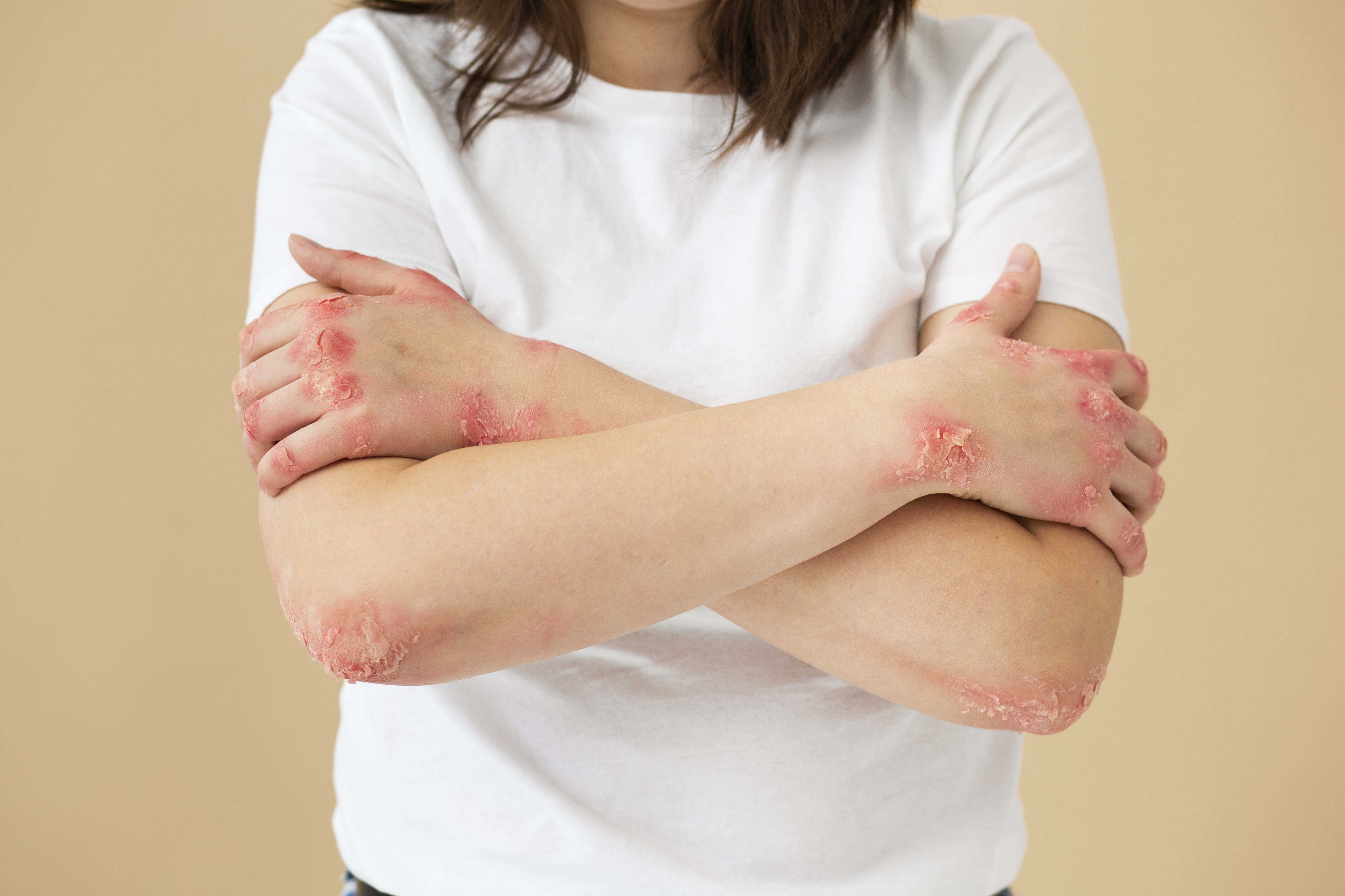 TSW Eczema Treatment: Steroid-Free Healing Methods