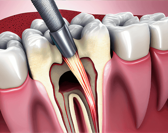 How Dubai Clinics Make Root Canals Easy