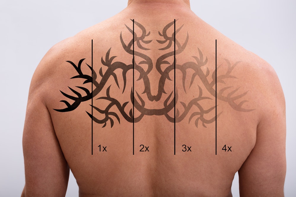 Can You Remove Tattoos on Sensitive Areas with Laser