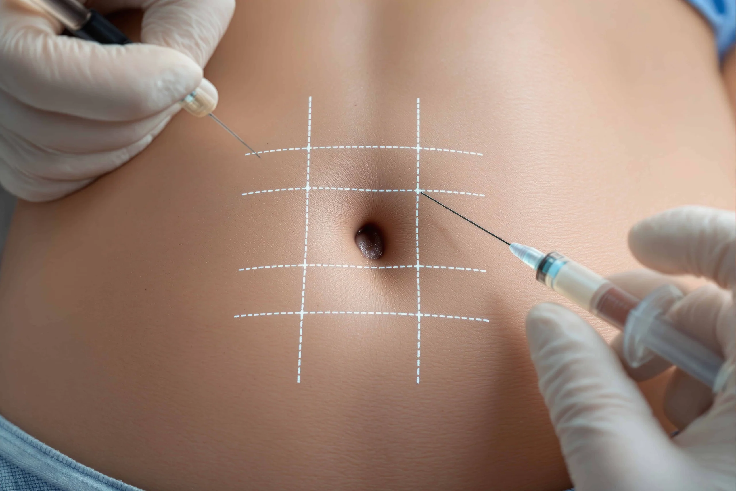 How Do I Choose the Right Laser Lipo Provider?