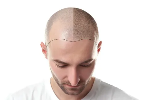 Low-Cost Hair Transplant in Islamabad: Are You Compromising on Quality?