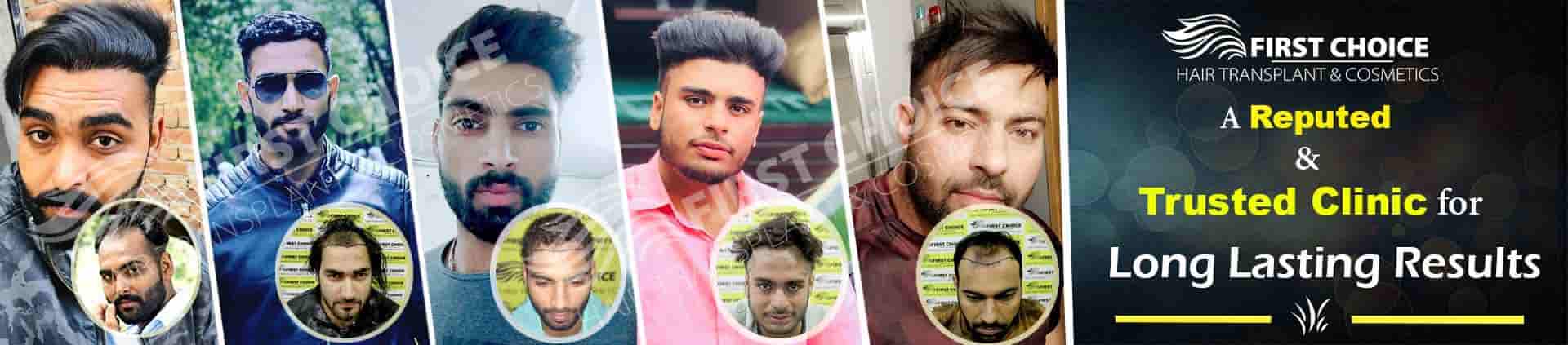 Regain Your Confidence with Advanced Hair Transplant Techniques in Chandigarh and Ludhiana