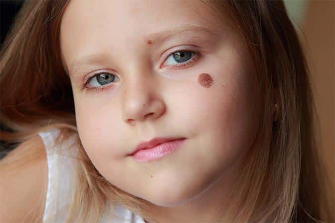 What Are the Benefits of Non-Invasive Birthmark Removal?
