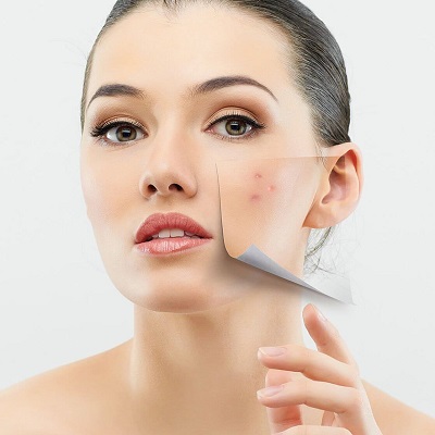 How is acne scars removal done in Islamabad?