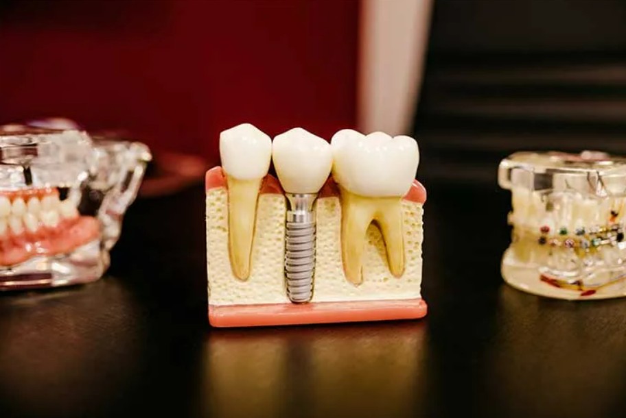 Expert Dentist in Gurgaon for Advanced Root Canal Treatment in Gurgaon