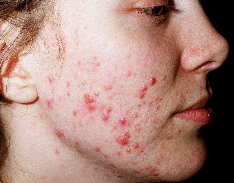 How to Fade Acne Scars through Treatment