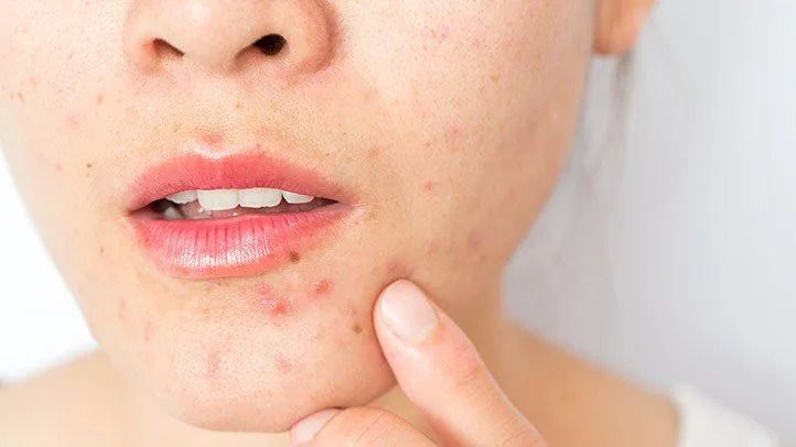 How to Avoid Breakouts: Your Ultimate Guide to Clear, Healthy Skin