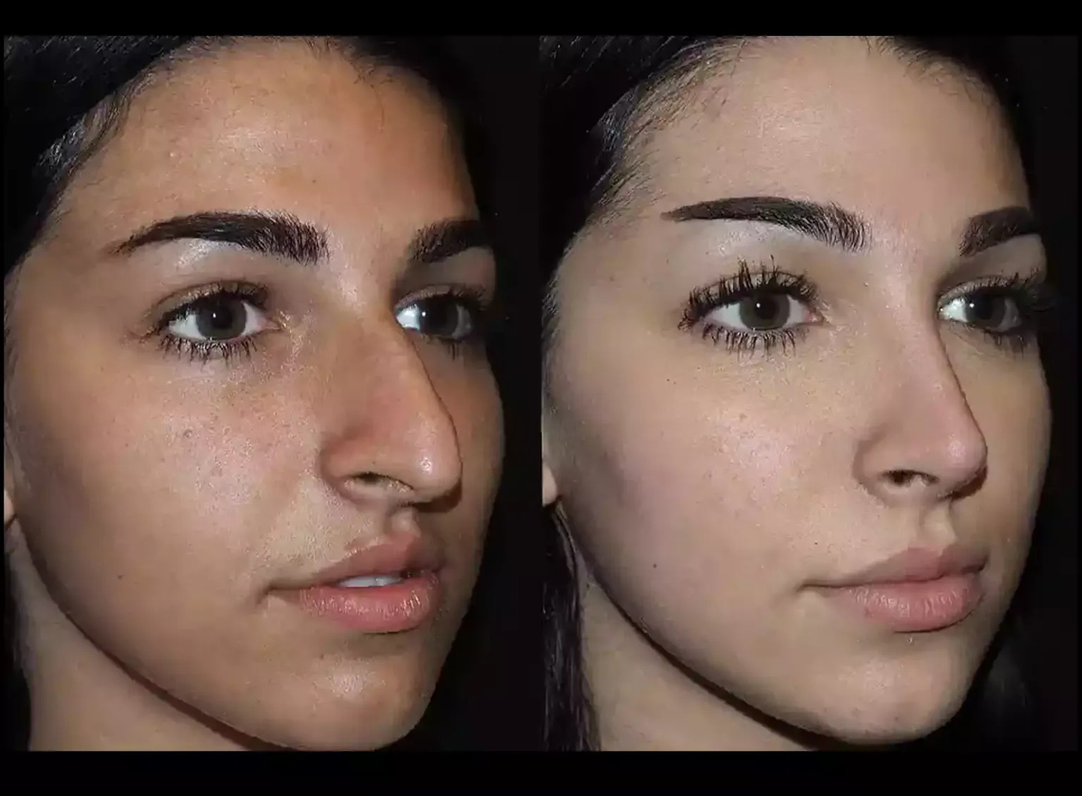 The Best Doctors in Dubai for Treating Deviated Septum with Septoplasty