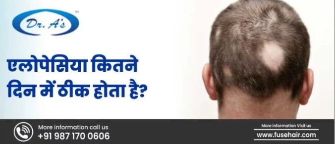 एलोपेसिया कितने दिन में ठीक होता है | Hair Transplant Clinic in Delhi