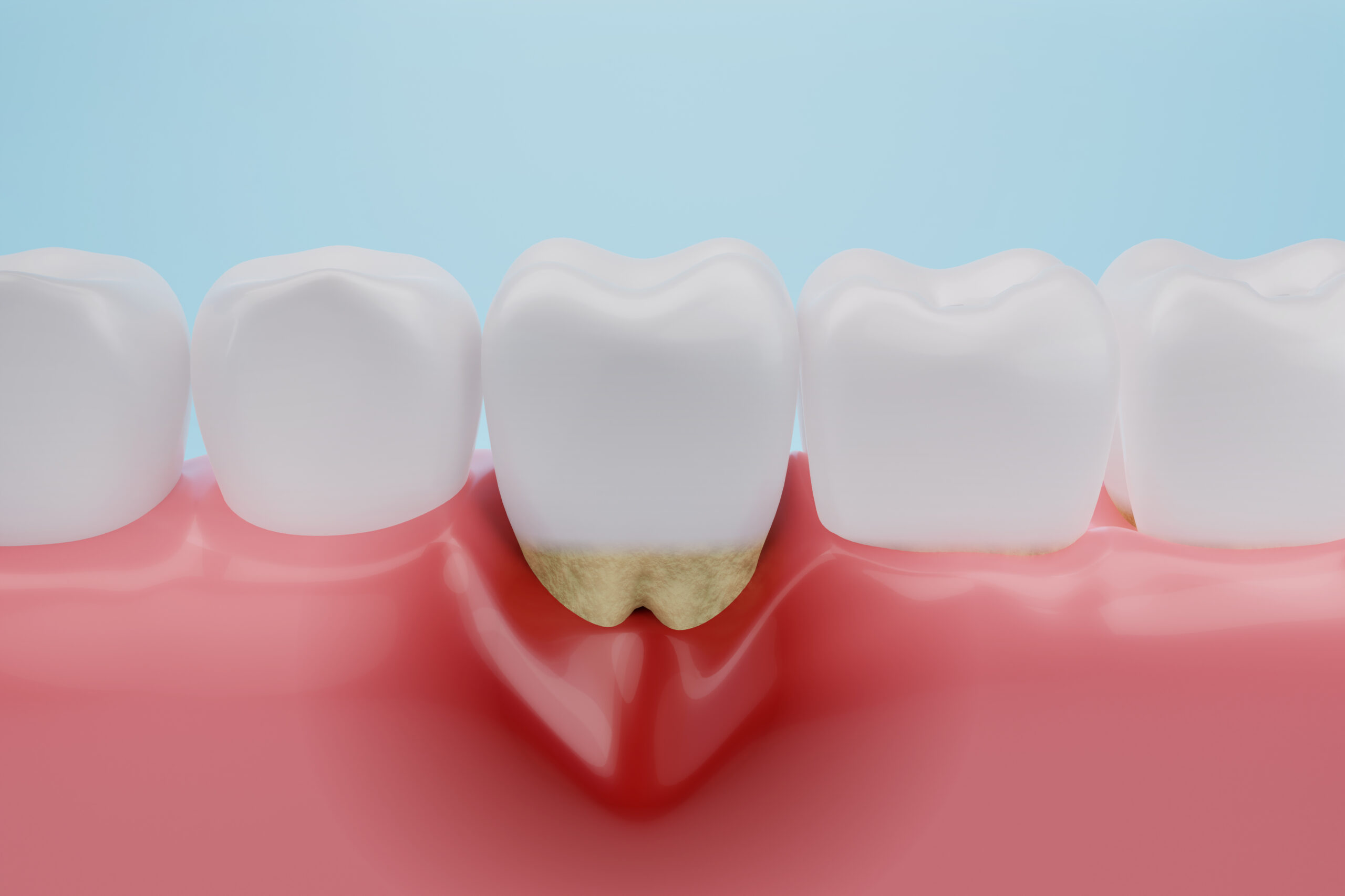 Is gum recession surgery necessary?