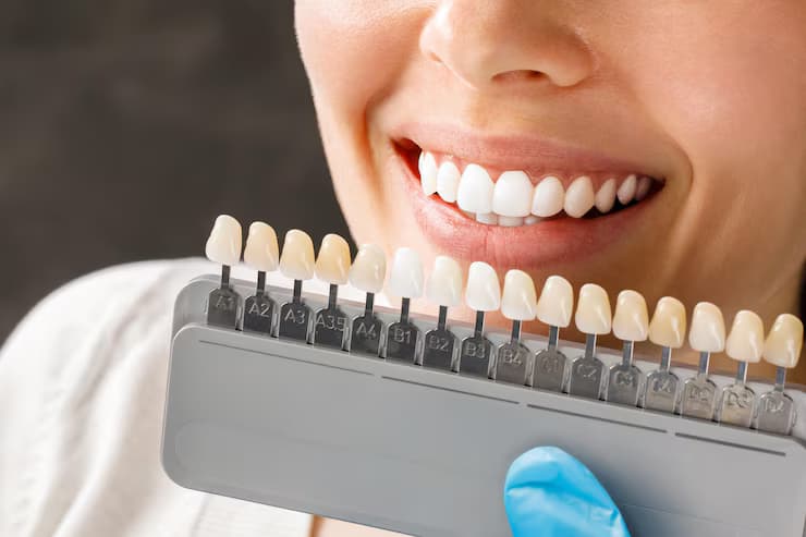 How Porcelain Veneers in Riverpark Transform Smiles