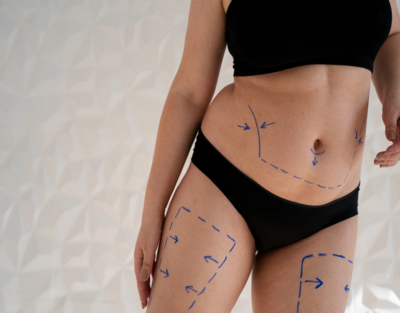 Choose Laser Liposuction in Dubai for a Slim New You