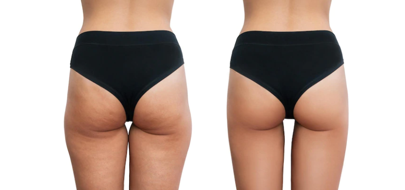 Brazilian Butt Lift (BBL) Surgery in India: Comprehensive Guide to Costs, Procedures, and Clinics