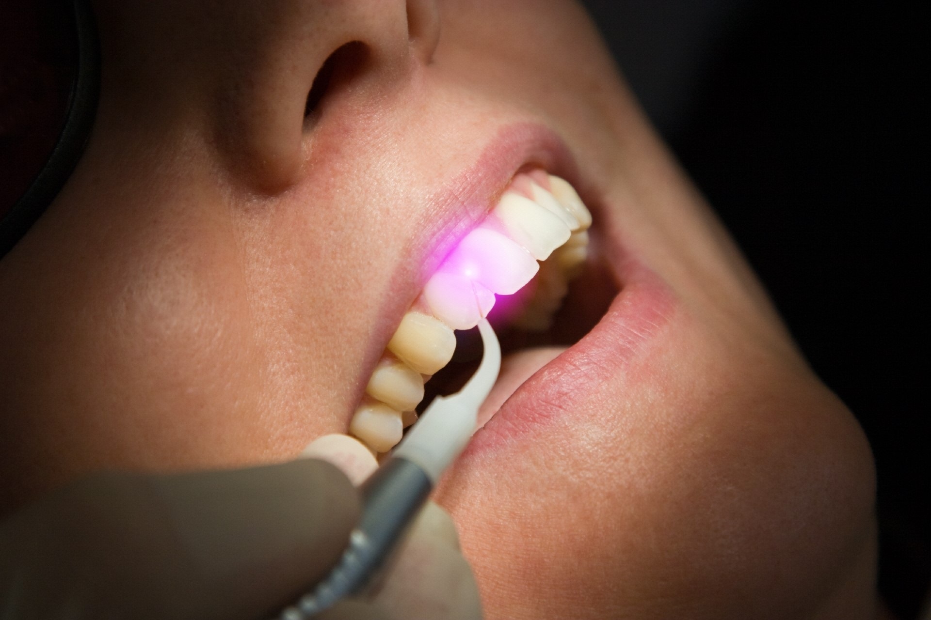Is pinhole gum surgery painful?