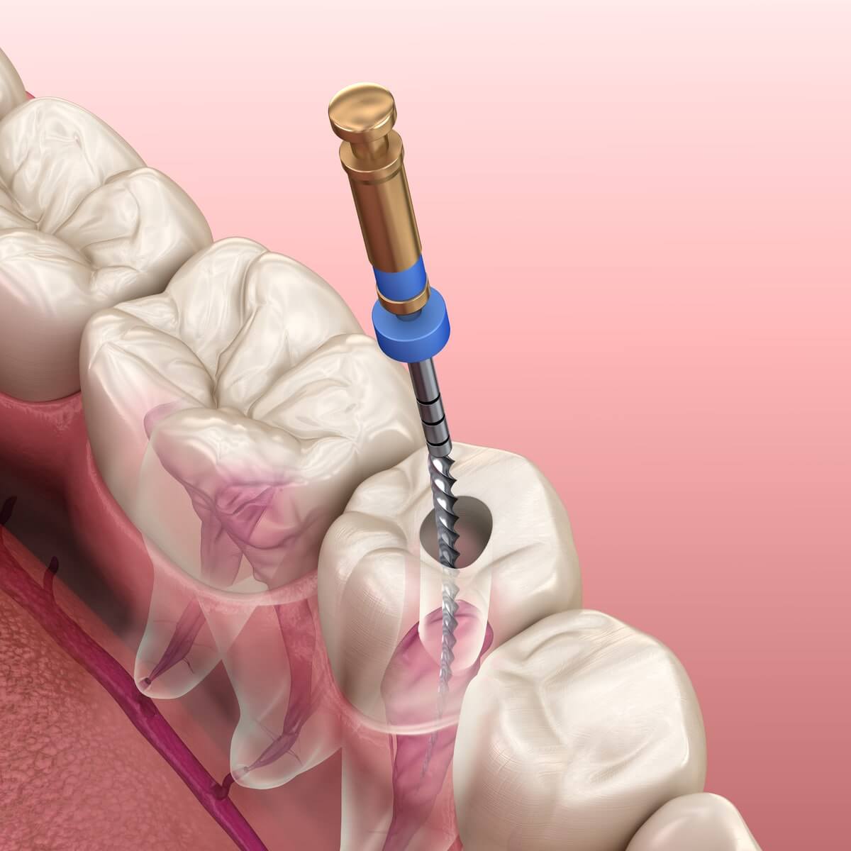 How Dubai Dentists Perform Root Canals