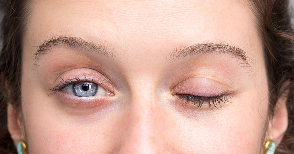Facial Palsy Treatment in London: Your Options