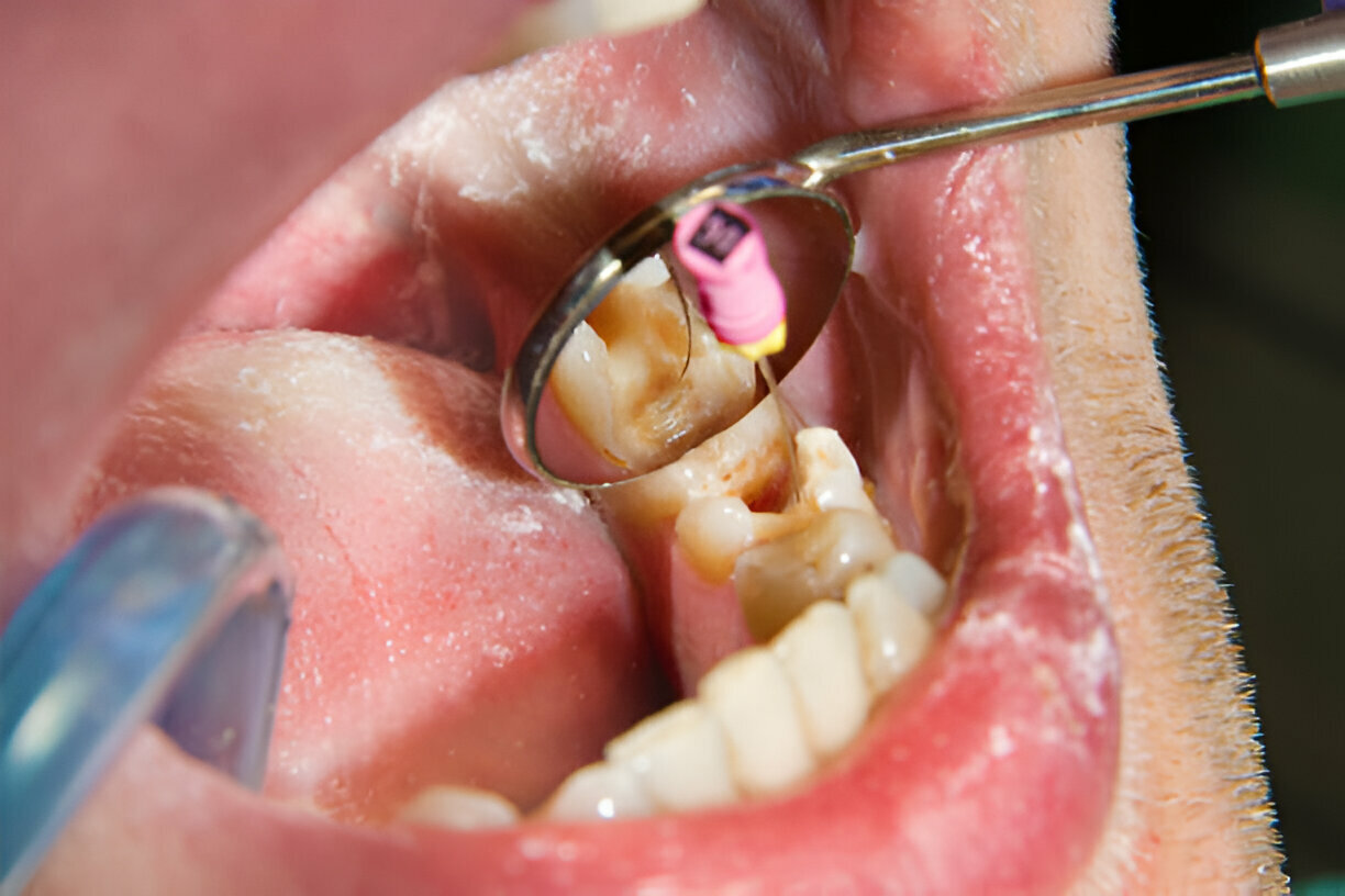 Root Canal Treatment: What to Expect and How Navarro Dental in Corsicana Ensures a Pain-Free Experience