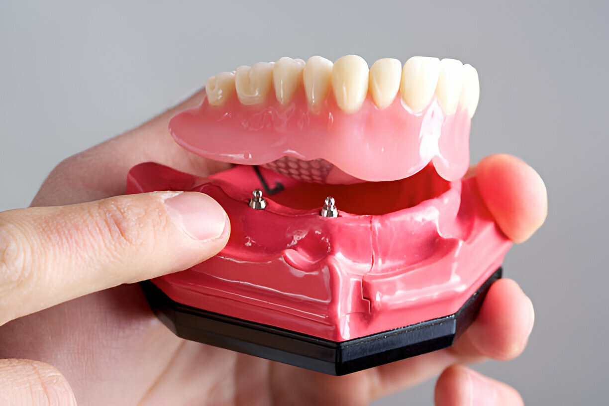 Why Dentures from A Trusted Dentist in Bloomfield at Sundance Dental Can Transform Your Smile