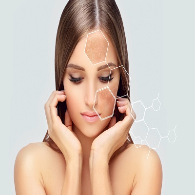 What are the side effects of melasma treatments?