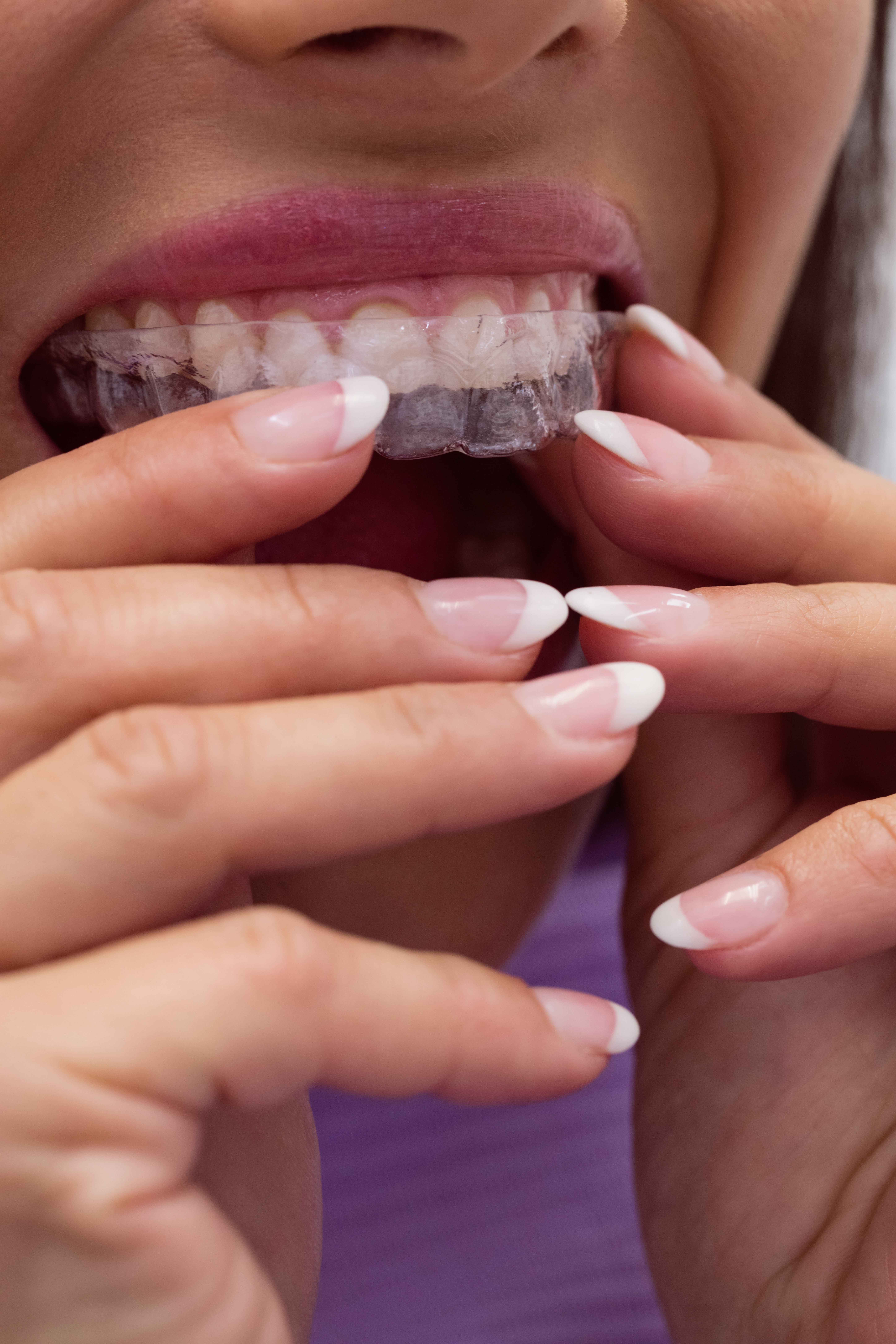 What Athletes and Nighttime Teeth Grinders Have in Common