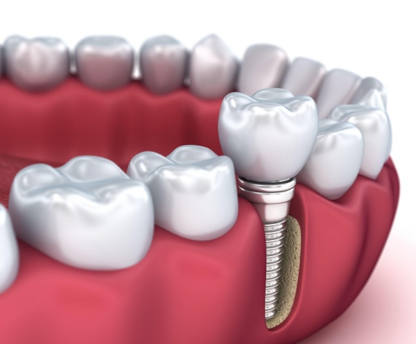 Trồng răng implant mất bao lâu? Bác sĩ giải thích chi tiết từng giai đoạn