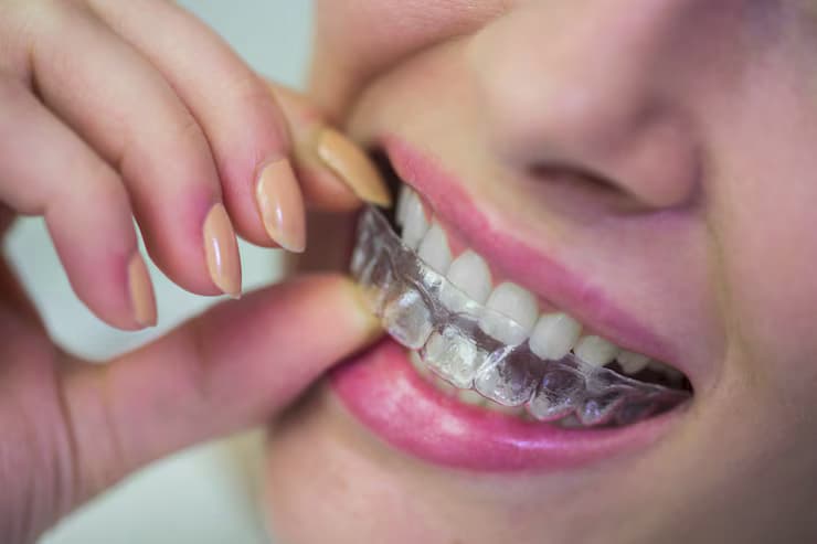 How to Save on Invisalign Without Cutting Corners