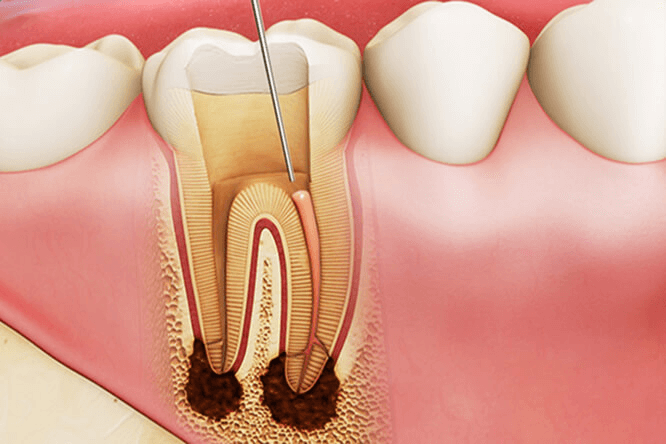 Chi phí trám răng sâu bao nhiêu? Những điều cần biết để điều trị hiệu quả và tiết kiệm