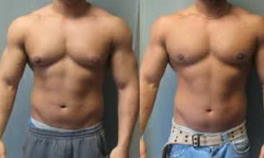 Male Breast Surgery Cost Guide in Dubai