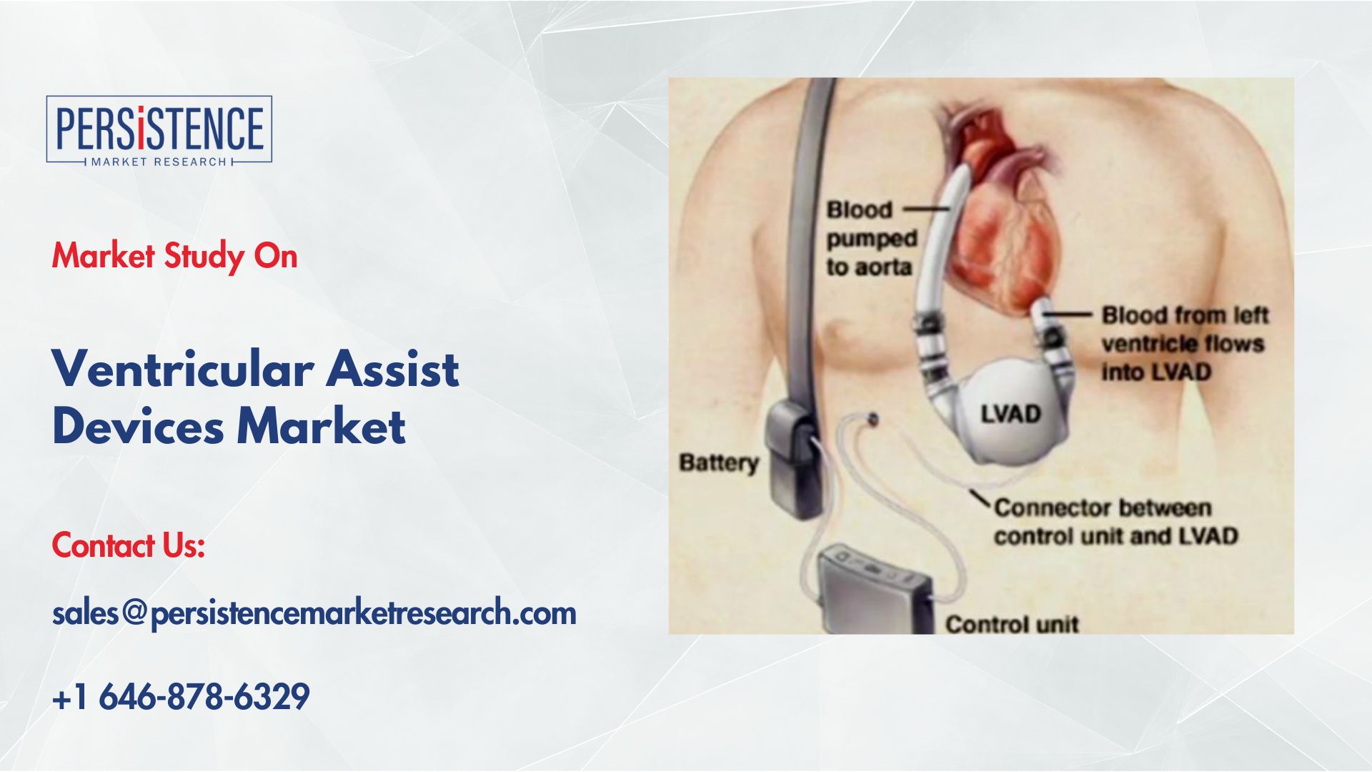 Ventricular Assist Devices Market Regional Insights and Growth Opportunities