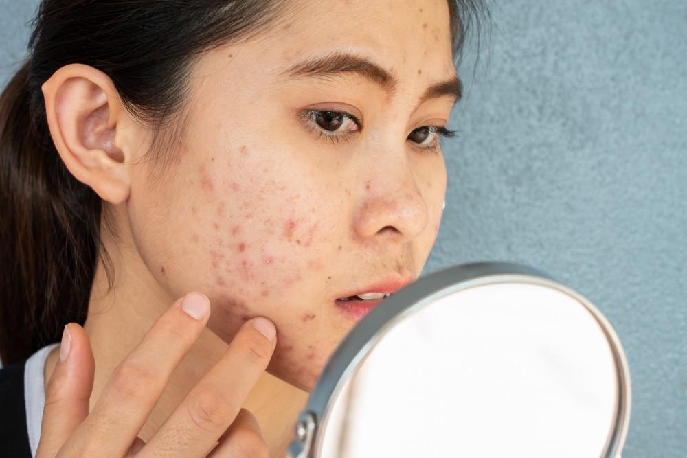 Proven Acne Treatment Hacks to Get Clear Skin Without the Stress
