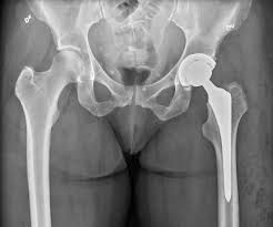 Hip Replacement in Lahore: A Comprehensive Guide for 2025