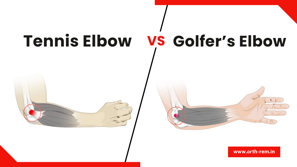 Tennis Elbow vs Golfer’s Elbow: What’s the Difference?