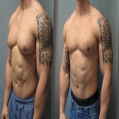 Dubai Gynecomastia Surgery Prices: Full Breakdown